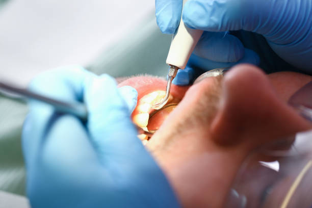 Best Broken or Chipped Tooth Repair in Fallbrook, CA